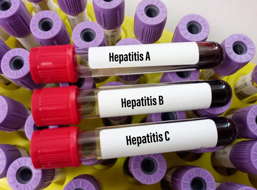 Dr Ivana Milošević: Hepatitis nema specifične simptome, treba se testirati makar jednom u životu